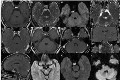 The imaging dynamic changes in the malignant transformation of an epidermoid cyst: a case report and literature review